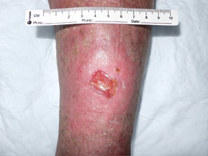 Die Volksmethoden der Pigmentation auf der Person